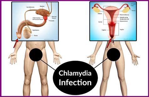19 Home Remedies For Chlamydia In Men And Women