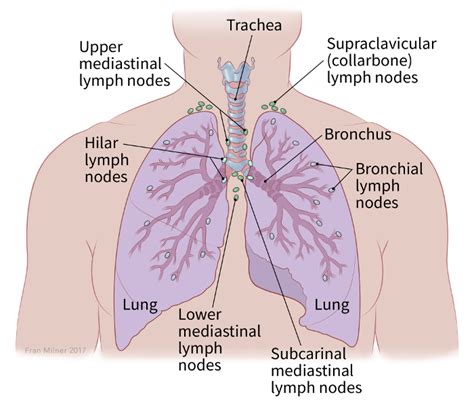 Non Small Cell Lung Cancer Staging Stages Of Lung Cancer American