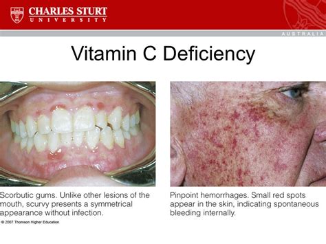 Vitamine What Is The Cause Of Vitamin C Deficiency