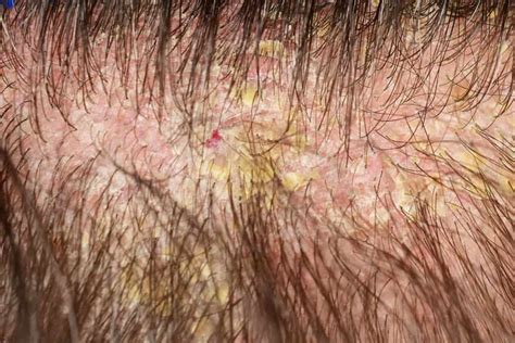 neglecting  scalp cambridge therapeutics