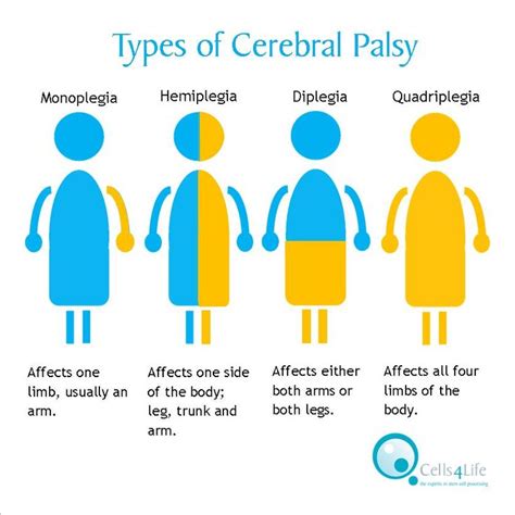 Cerebral Palsy Compensation Claims Ibb Claims