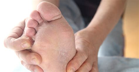 Skin Peeling Between Foot Toes Possible Causes