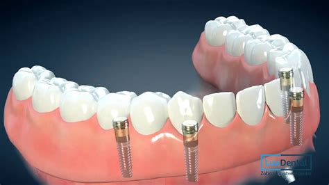 lux dental zobozdravstveni center implantologija youtube