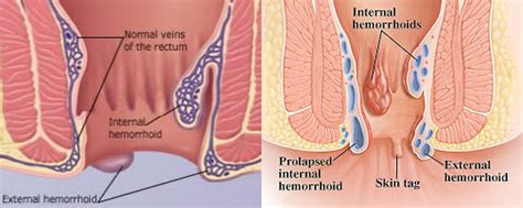 internal hemorrhoids treatment and it s causes and symptoms hemorrhoids treatment guide