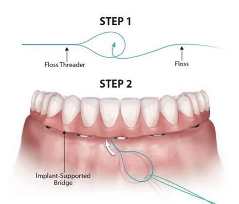 clean    dental implants moorooka