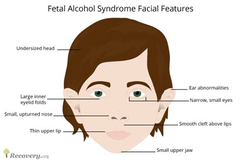 fetal alcohol syndrome treatment effects symptoms and facts