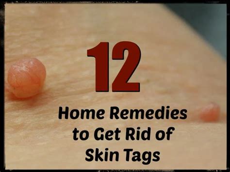 12 home remedies for skin tags — info you should know in 2020 home