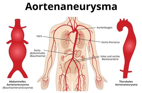 aneurysma der aorta ursachen symptome behandlung