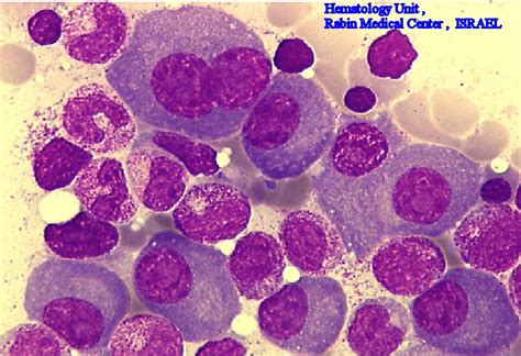 multiple myeloma cancer medicinebtgcom