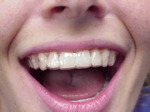retainers riviera orthodontics