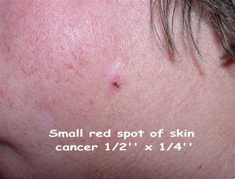 result images  white spots  skin cancer png image collection