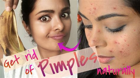 video how to get rid of pimples overnight really works