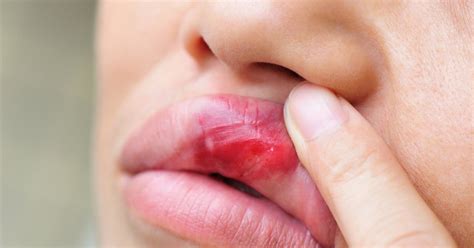 How To Get Rid Of A Herpes Sore Livestrong