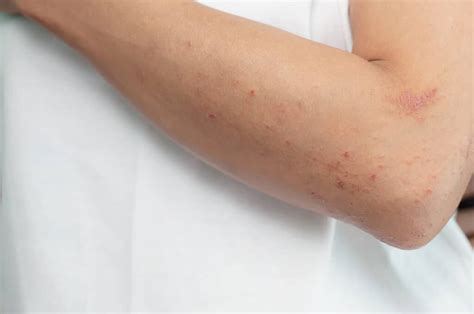 skin lesions learn       fix  waxelene