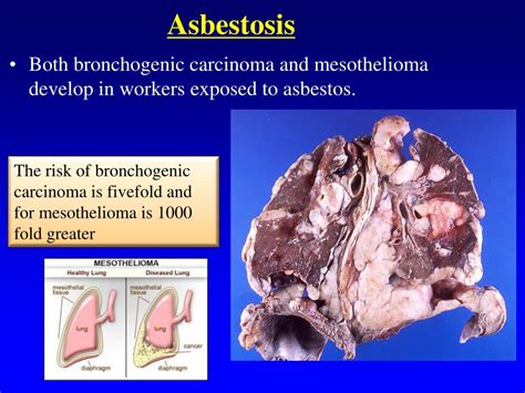 Ppt Restrictive Lung Diseases Powerpoint Presentation Free Download