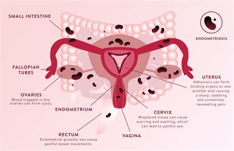 This Is What Endometriosis Does To Your Body Sheknows