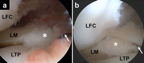Complete Tear Of The Lateral Meniscus Posterior Root Is Associated With