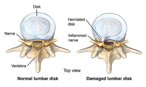 lumbar disk disease herniated disk cedars sinai