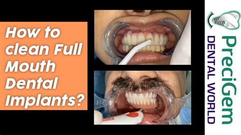 clean full mouth dental implants  dental implant surgeon