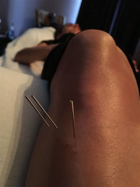 The Benefits Of Acupuncture Eastern Vs Western Medicine