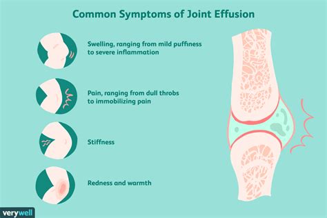 joint effusion symptoms  diagnosis treatment