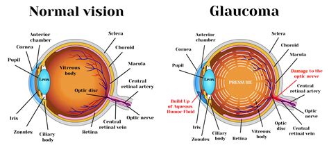 glaucoma learn  glaucoma glaucoma resources