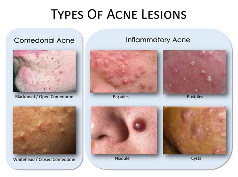 Acne What’s The Deal