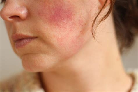Red Blotches On Face Treatment Pictures Causes Of Red