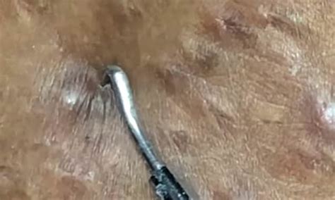 Nauseating Video Shows Ingrown Hairs Being Squeezed From A Womans