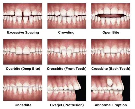 Common Bite Problems Orthodontist Orthodontist Auckland
