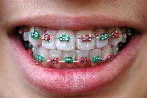 metal braces  clear braces bali implant aesthetic bia dental center