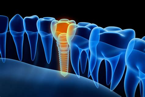 benefits  guided implant surgery lincoln ne  benefits  gui