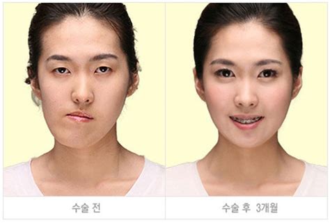 Before And After Photos Of Korean Plastic Surgery Part 2