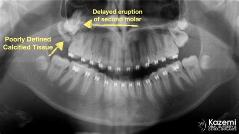 Delayed Eruption Of Second Molar Blocked By Impacted And Malformed