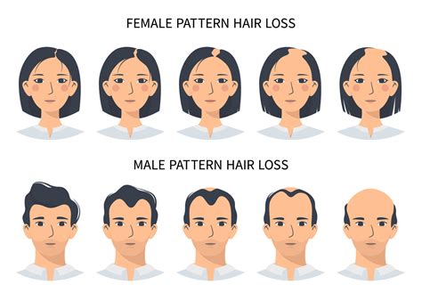 hair loss stages androgenetic alopecia male  female pattern steps  baldness vector