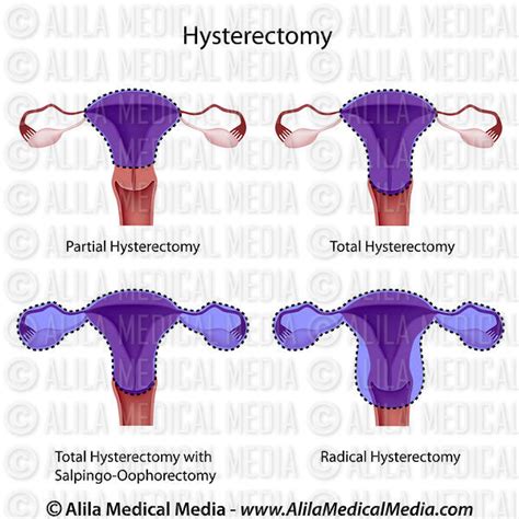 Alila Medical Media Hysterectomy Surgical Removal Of The Uterus