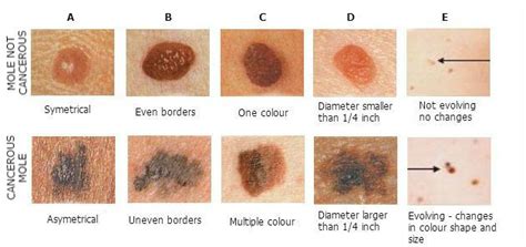 Cancerous Moles – Signs Types Pictures Cancerous Mole On The Back Neck