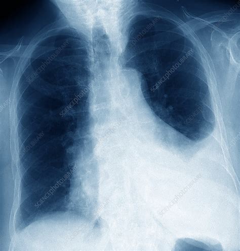 Lung Infection X Ray Stock Image M240 0643 Science Photo Library