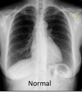 abnormal chest  ray   means   chestmed