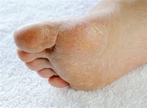 common skin problems   feet