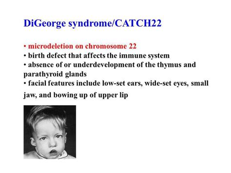 digeorge syndrome medizzy