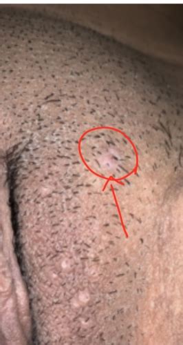 can warts grow hair are these genital warts help sexual health