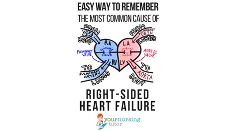 easily remember   common    sided heart failure