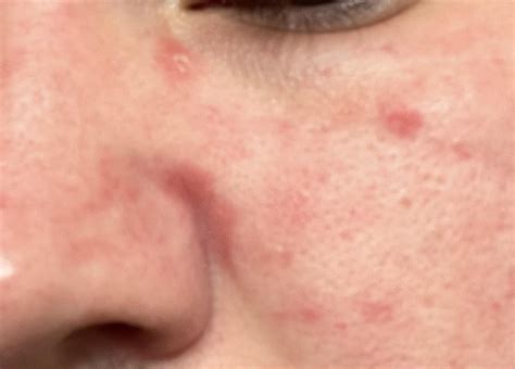 red scaly patches  face rdermatologyquestions