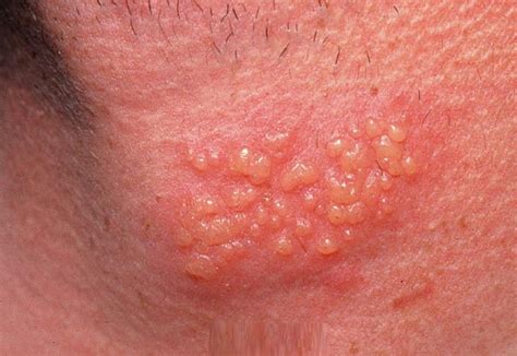 genital herpes causes symptoms pictures treatment prevention diseases pictures
