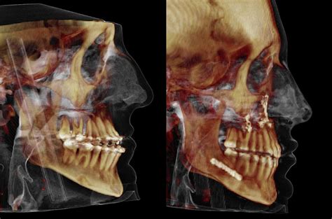 contouring   mandible maxillary advancement corrective jaw surgery dr antipov