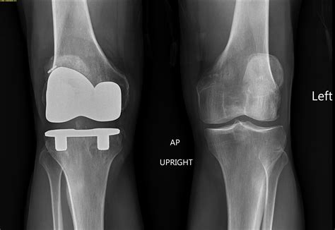 fall damage  knee replacement parmeldesign