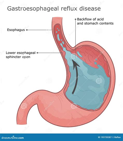 gastroesophageal reflux disease illustration stock vector illustration  gastroenterology