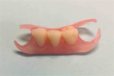 partial dentures beforeafter dr gentry
