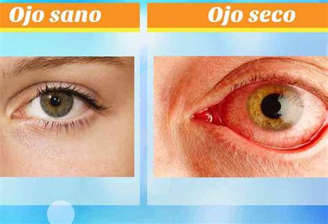 ¿qué es el síndrome del ojo seco teletica
